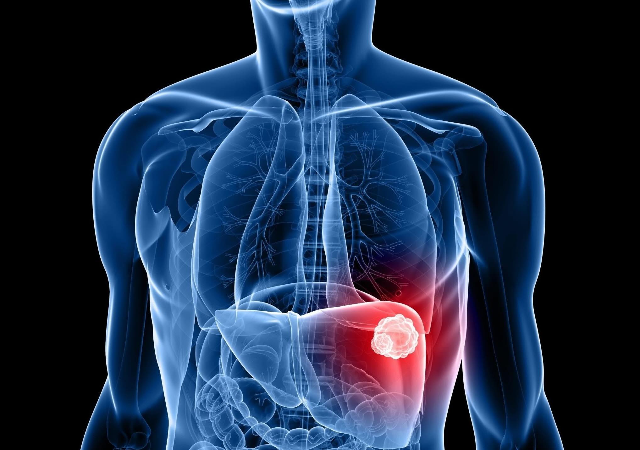 Liver Cancer Treatment