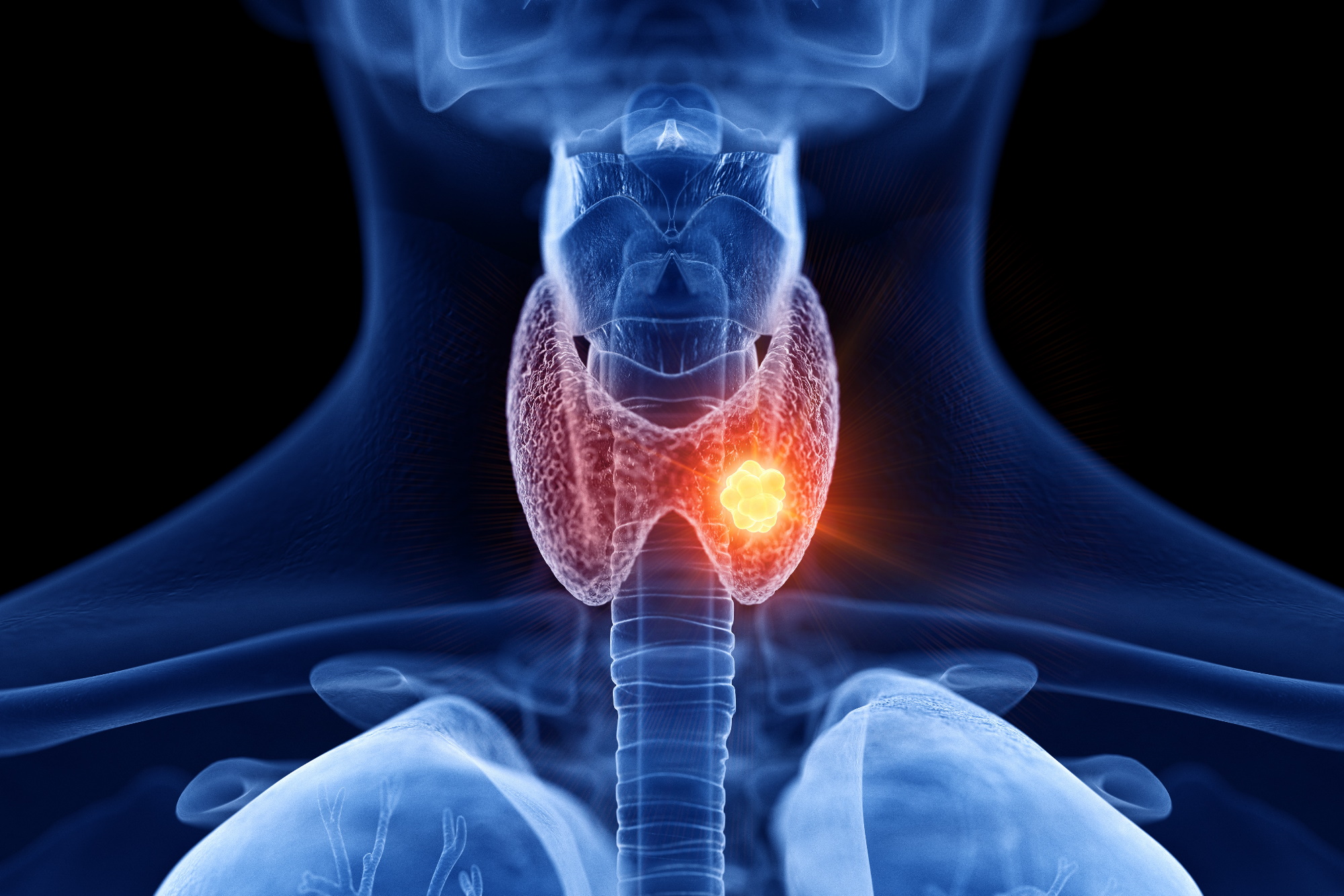 Thyroid Cancer Treatment