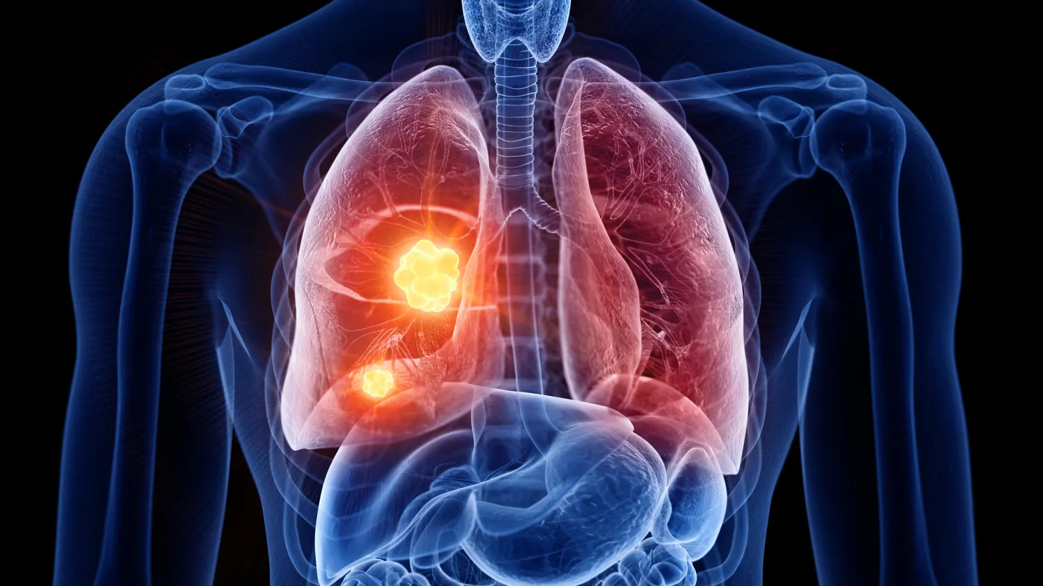 Thoracic Cancer Treatment